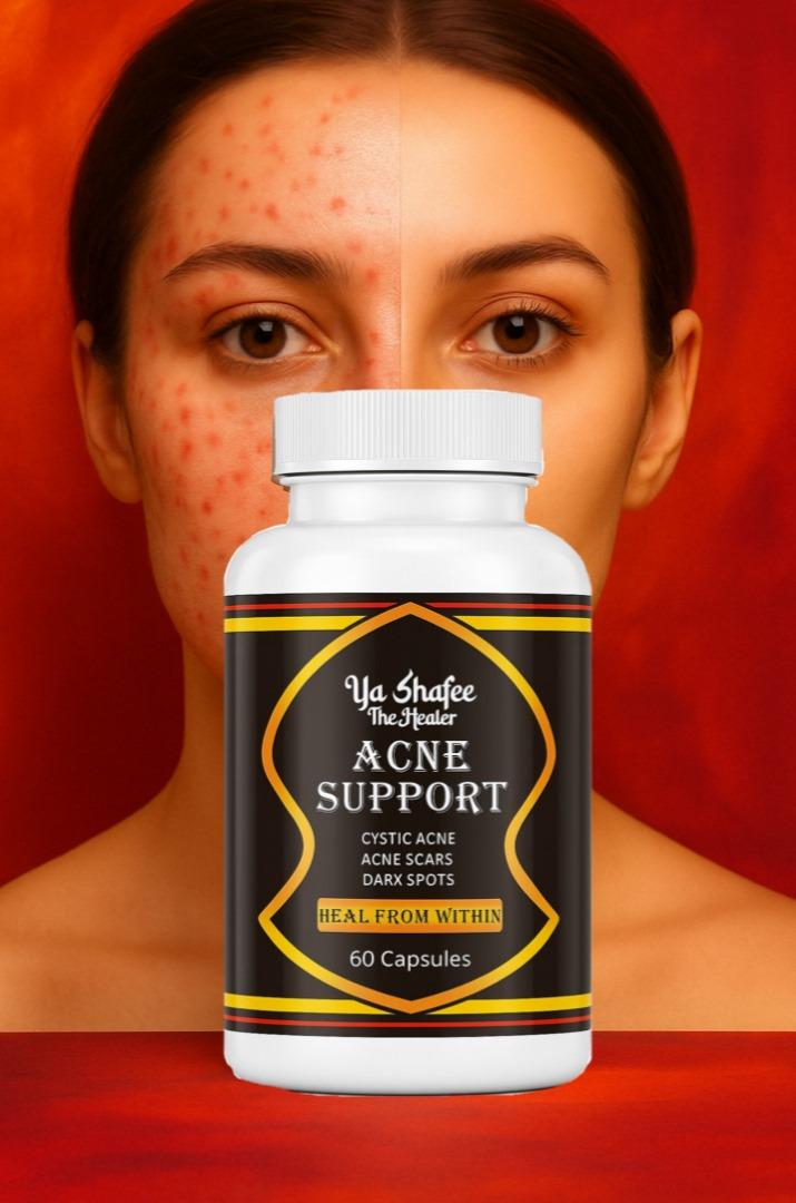 AcnE Support
